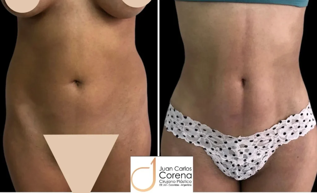 Lipomarcación abdominal - Dr. Juan Carlos Corena (3)
