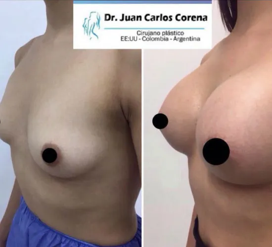 Mamoplastia de Aumento - Dr. Juan Carlos Corena (5)